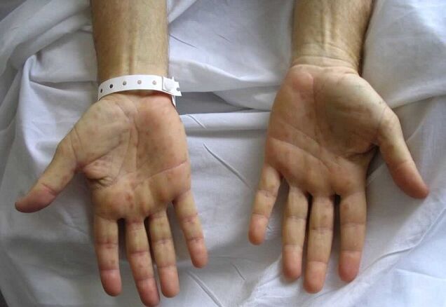 Syphilis in the hands as a cause of pathological discharge from the penis.